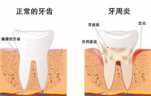牙周炎需要治疗多久