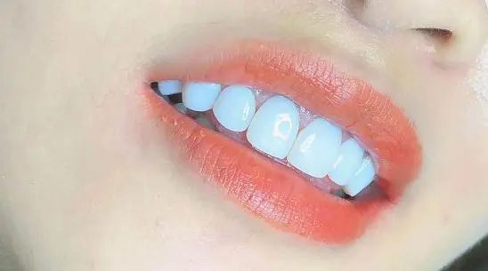 烤瓷牙寿命大揭秘