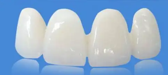 门牙瓷贴面能用多久