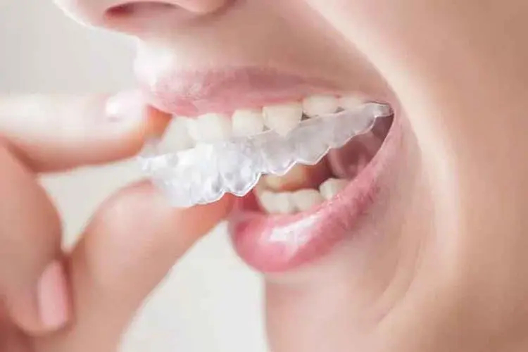 牙齿不整齐是做牙冠还是做牙齿矫正