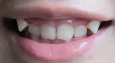 整牙齿前必须要先治疗牙周病吗