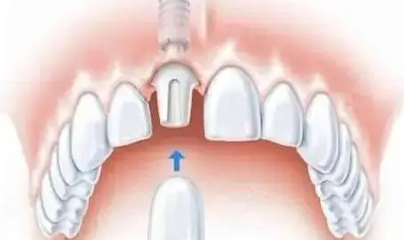 即拔即种技术的术后护理要点