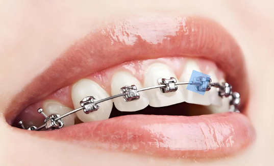 做牙齿矫正可以喝可乐吗