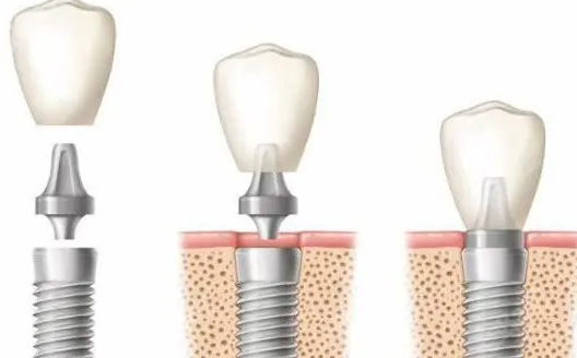 种植牙周围炎的防止