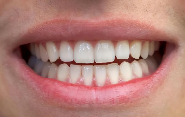 补牙之后还能做牙周治疗吗