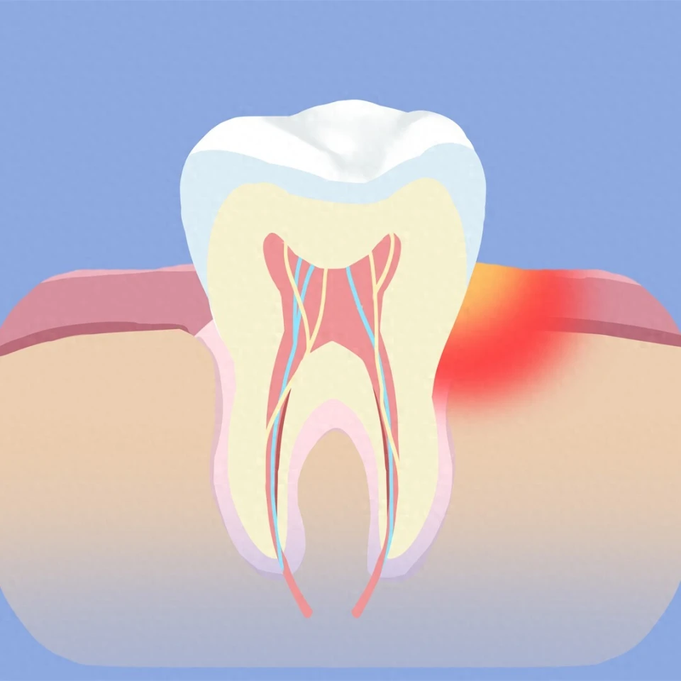 牙周炎的防止攻略